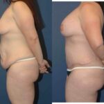 Mommy Makeover #15 - Before and After