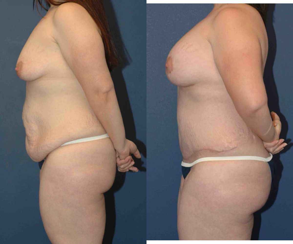 Mommy Makeover #15 - Before and After