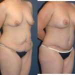 Mommy Makeover #15 - Before and After