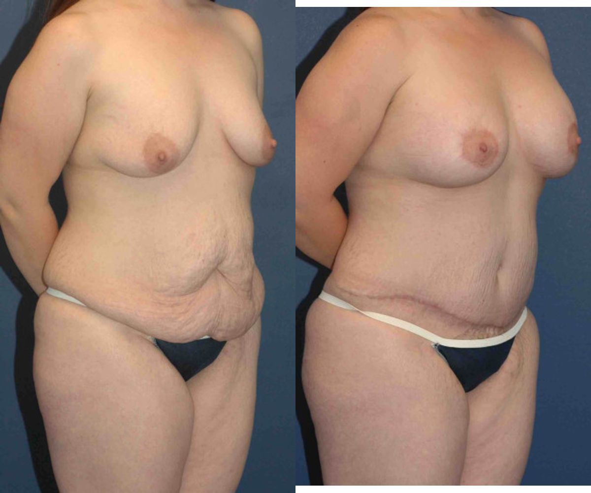 Mommy Makeover #15 - Before and After