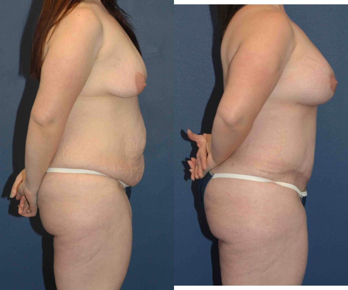 Mommy Makeover #15 - Before and After