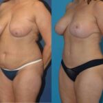 Mommy Makeover #16 - Before and After