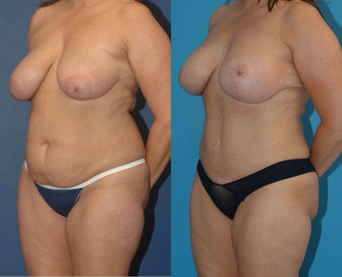 Mommy Makeover #16 - Before and After