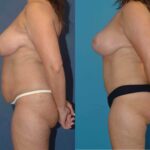 Mommy Makeover #16 - Before and After