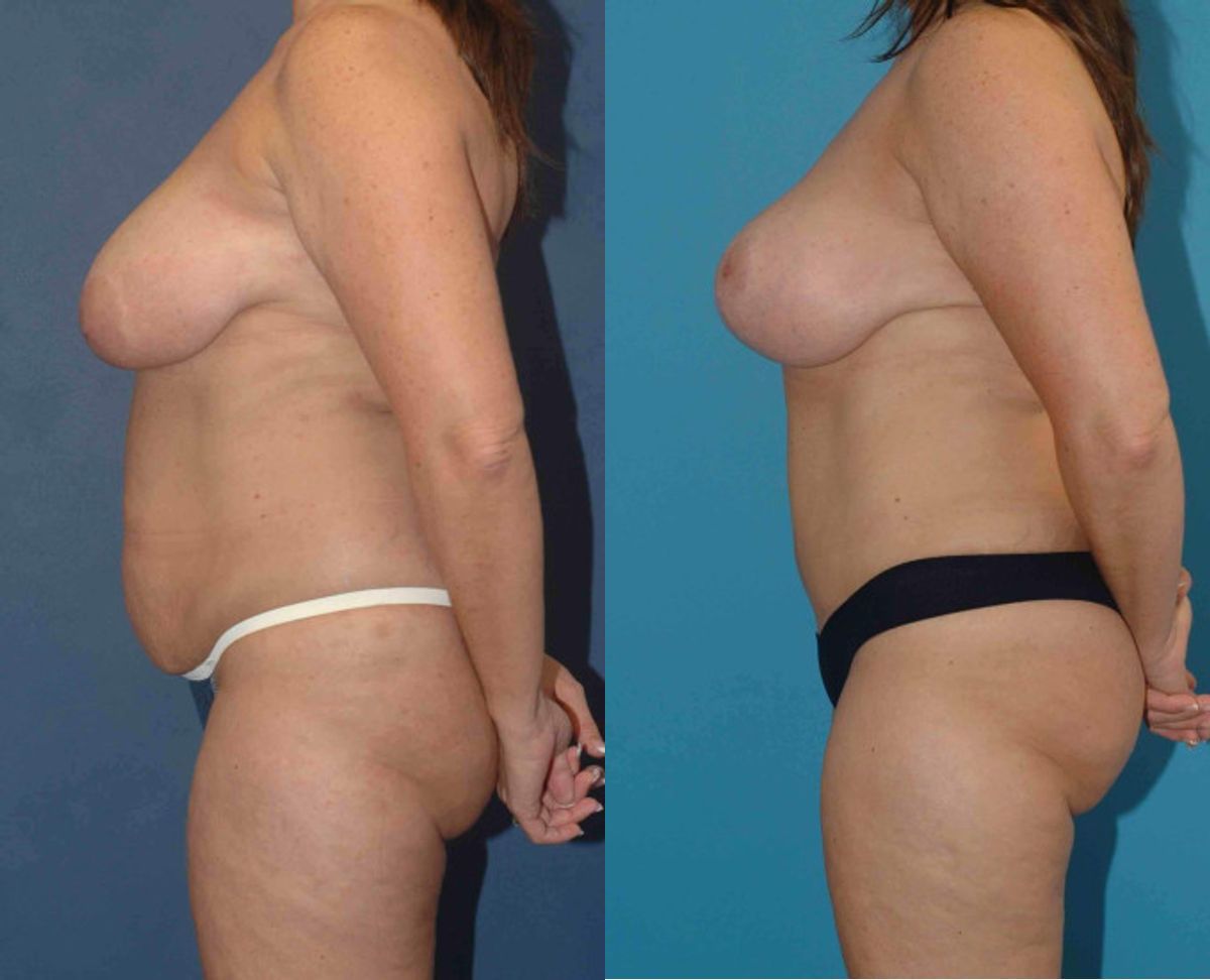 Mommy Makeover #16 - Before and After