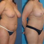 Mommy Makeover #16 - Before and After