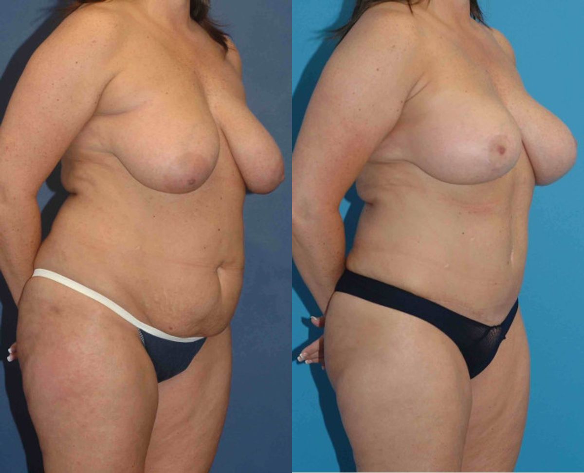 Mommy Makeover #16 - Before and After