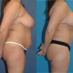 Mommy Makeover #16 - Before and After