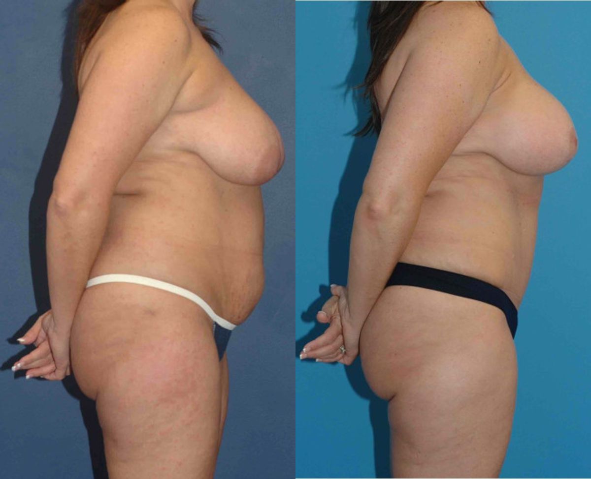 Mommy Makeover #16 - Before and After