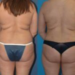 Mommy Makeover #16 - Before and After