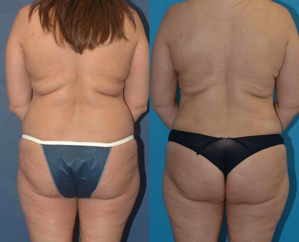 Mommy Makeover #16 - Before and After