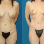 Mommy Makeover #17 - Before and After