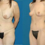 Mommy Makeover #17 - Before and After