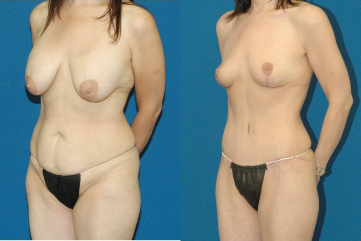 Mommy Makeover #17 - Before and After