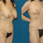 Mommy Makeover #17 - Before and After