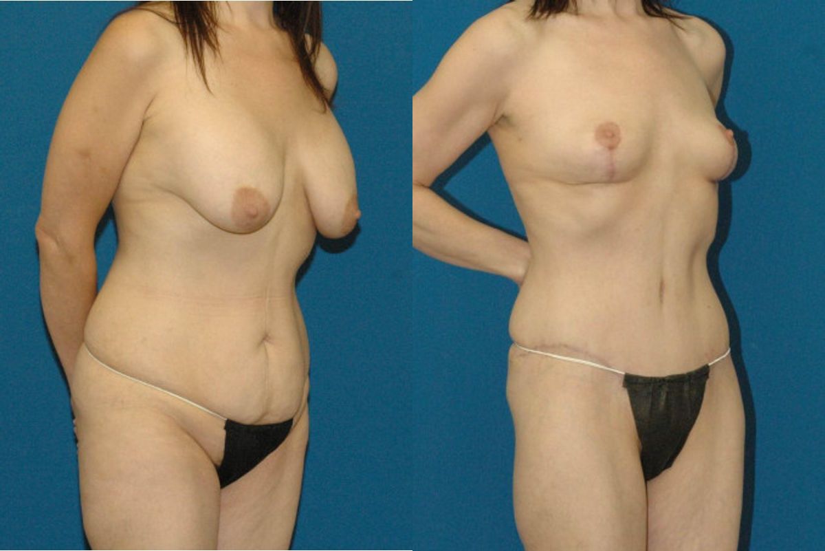 Mommy Makeover #17 - Before and After