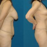 Mommy Makeover #17 - Before and After