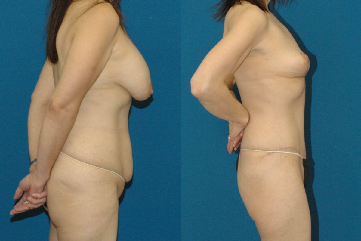 Mommy Makeover #17 - Before and After