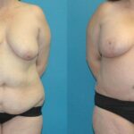 Mommy Makeover #18 - Before and After