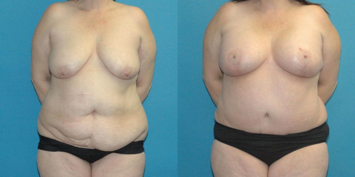 Mommy Makeover #18 - Before and After