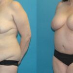 Mommy Makeover #18 - Before and After