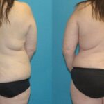 Mommy Makeover #18 - Before and After