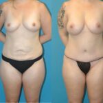 Mommy Makeover #19 - Before and After