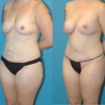 Mommy Makeover #19 - Before and After