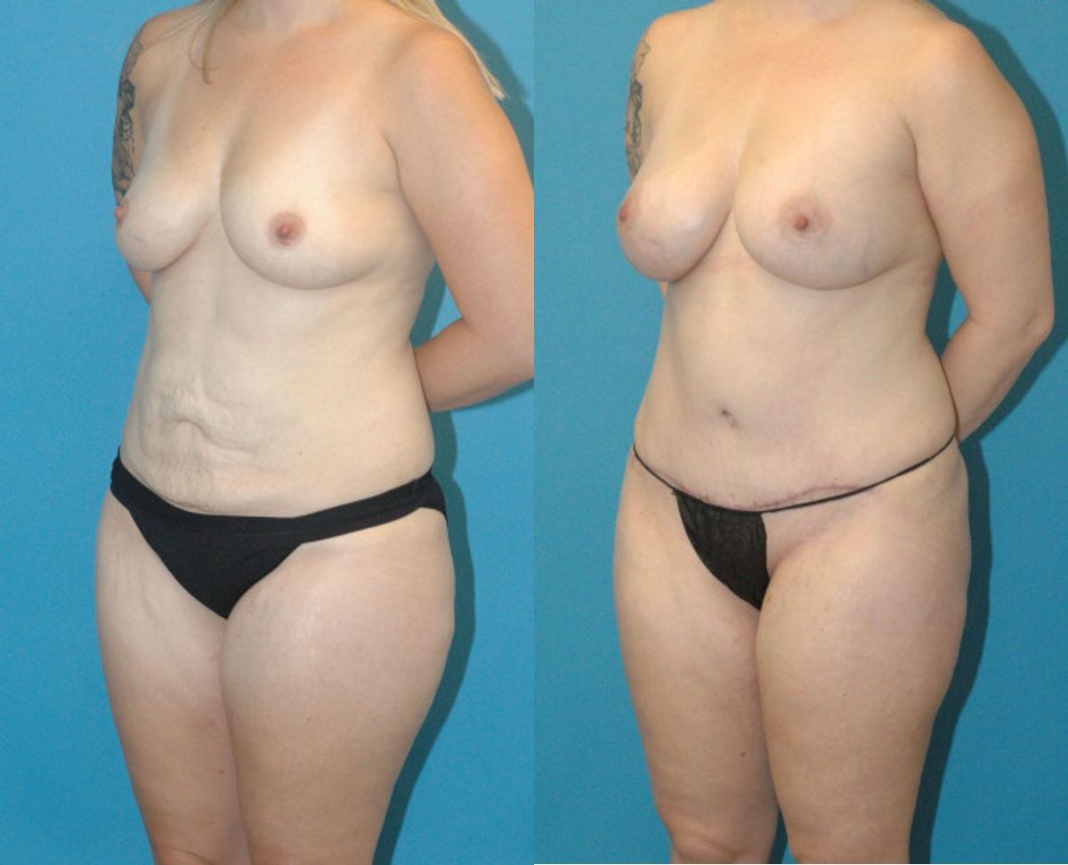 Mommy Makeover #19 - Before and After