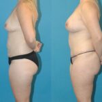 Mommy Makeover #19 - Before and After