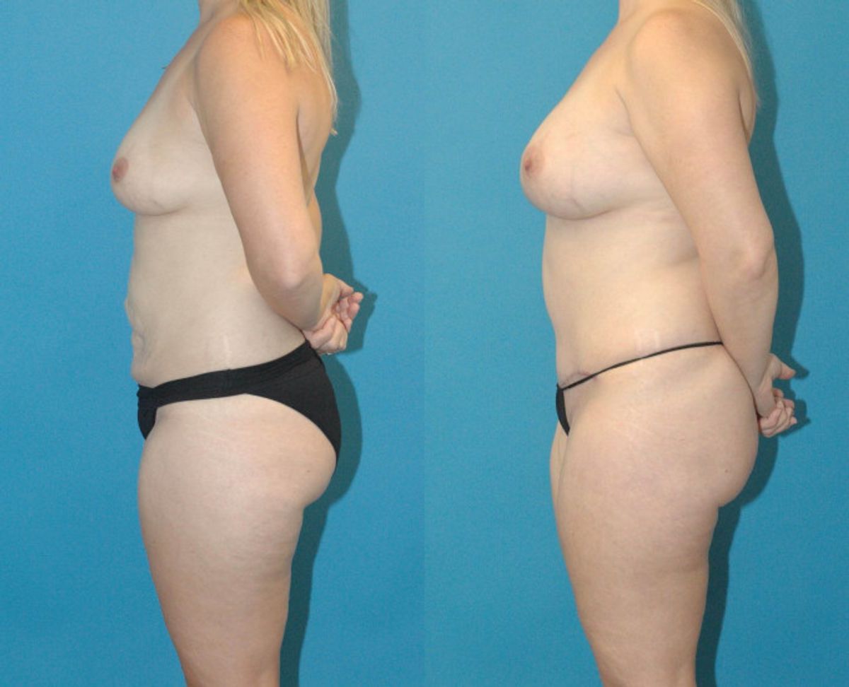 Mommy Makeover #19 - Before and After