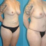 Mommy Makeover #19 - Before and After