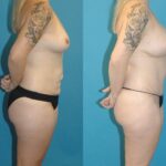 Mommy Makeover #19 - Before and After