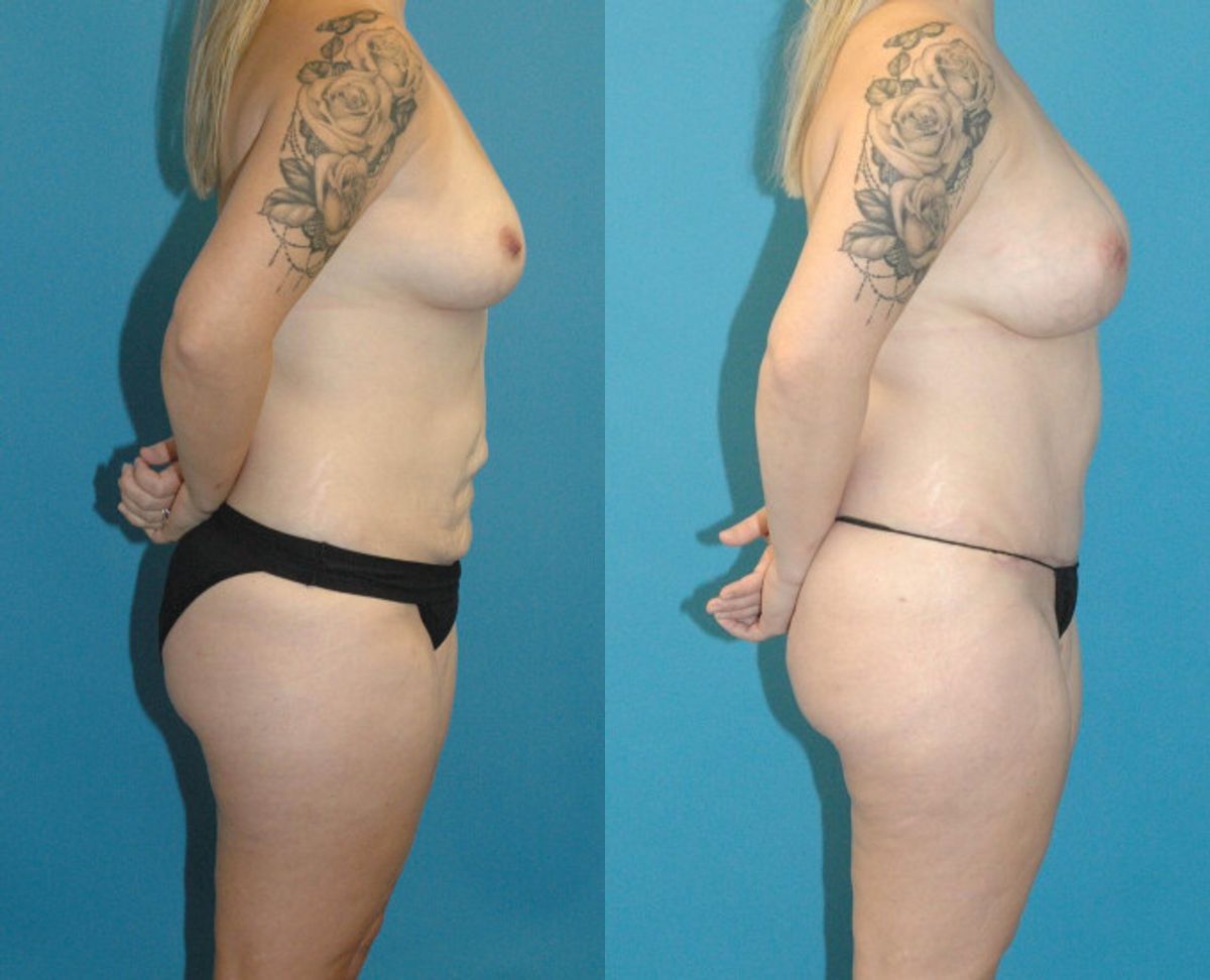 Mommy Makeover #19 - Before and After