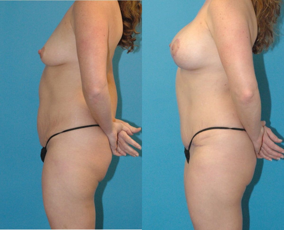 Mommy Makeover #20 - Before and After