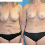 Mommy Makeover #21 - Before and After