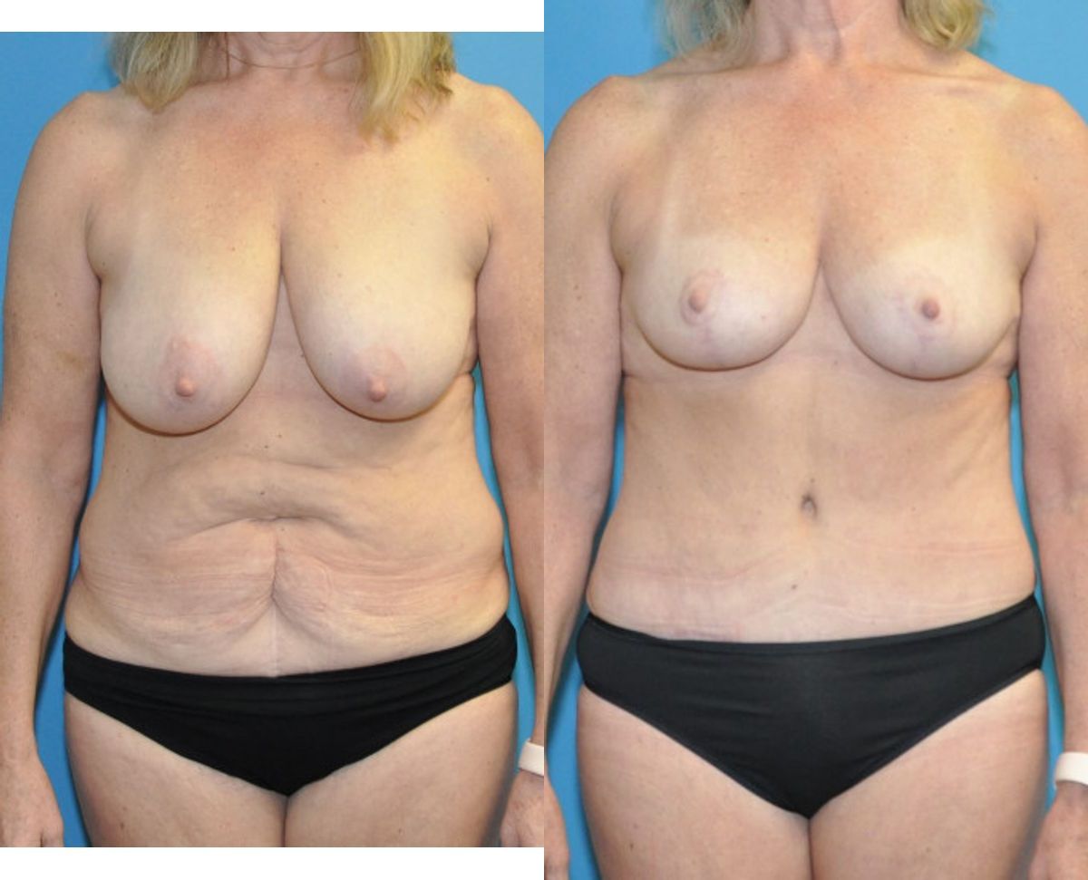 Mommy Makeover #21 - Before and After