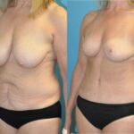 Mommy Makeover #21 - Before and After