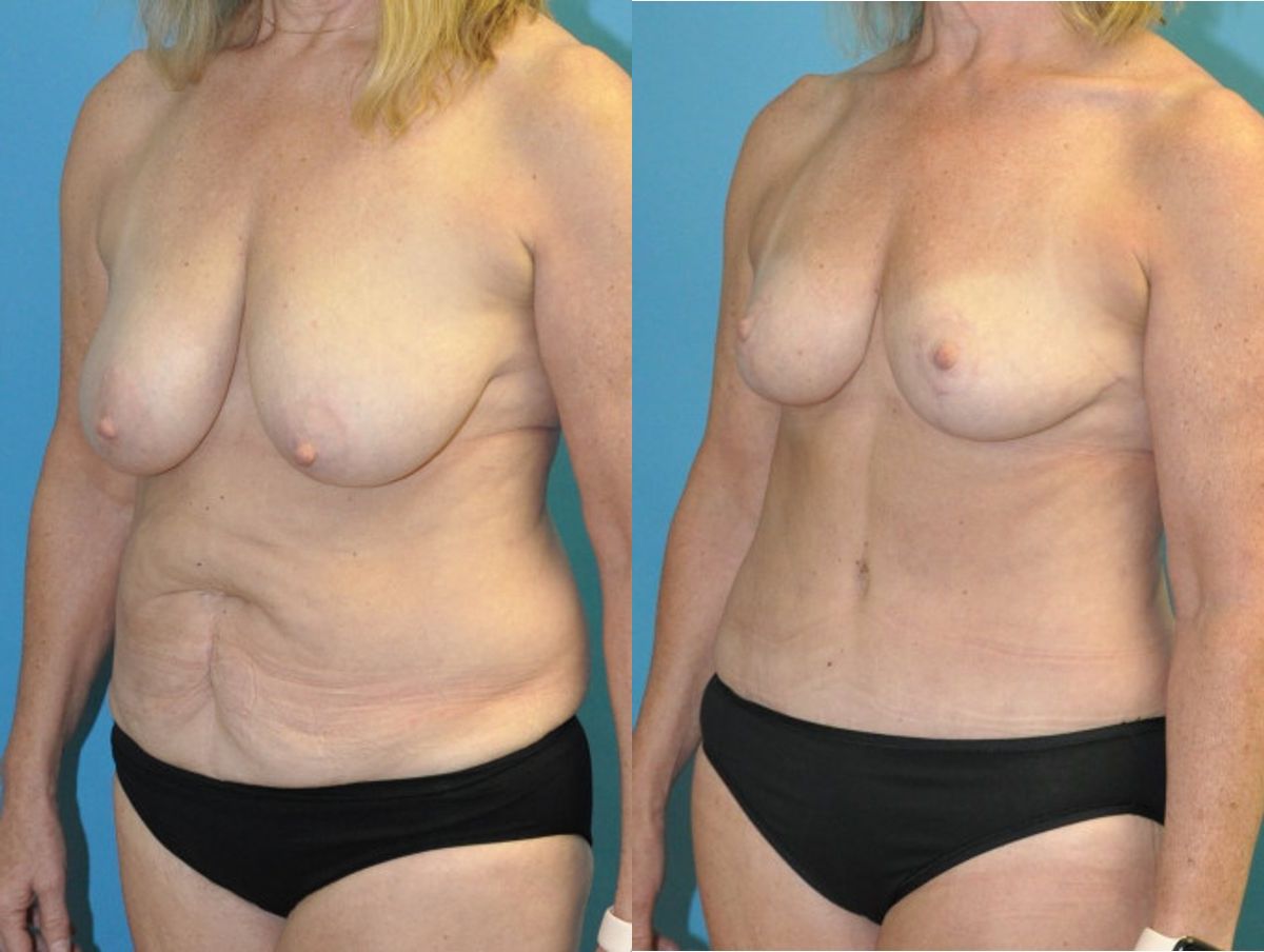 Mommy Makeover #21 - Before and After