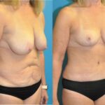 Mommy Makeover #21 - Before and After