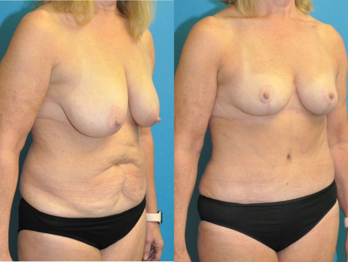 Mommy Makeover #21 - Before and After