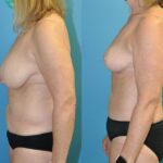 Mommy Makeover #21 - Before and After