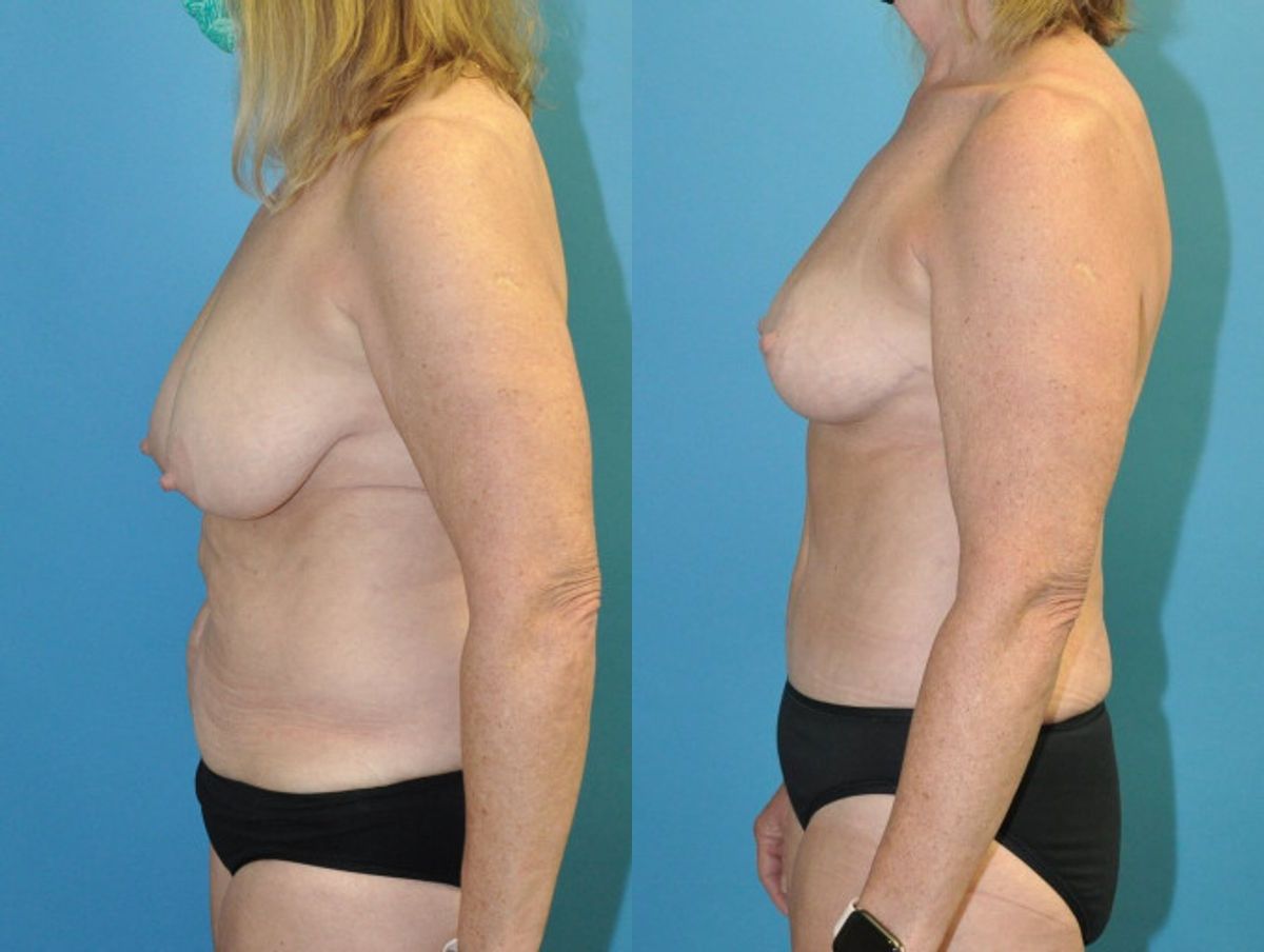 Mommy Makeover #21 - Before and After