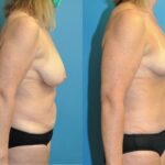 Mommy Makeover #21 - Before and After