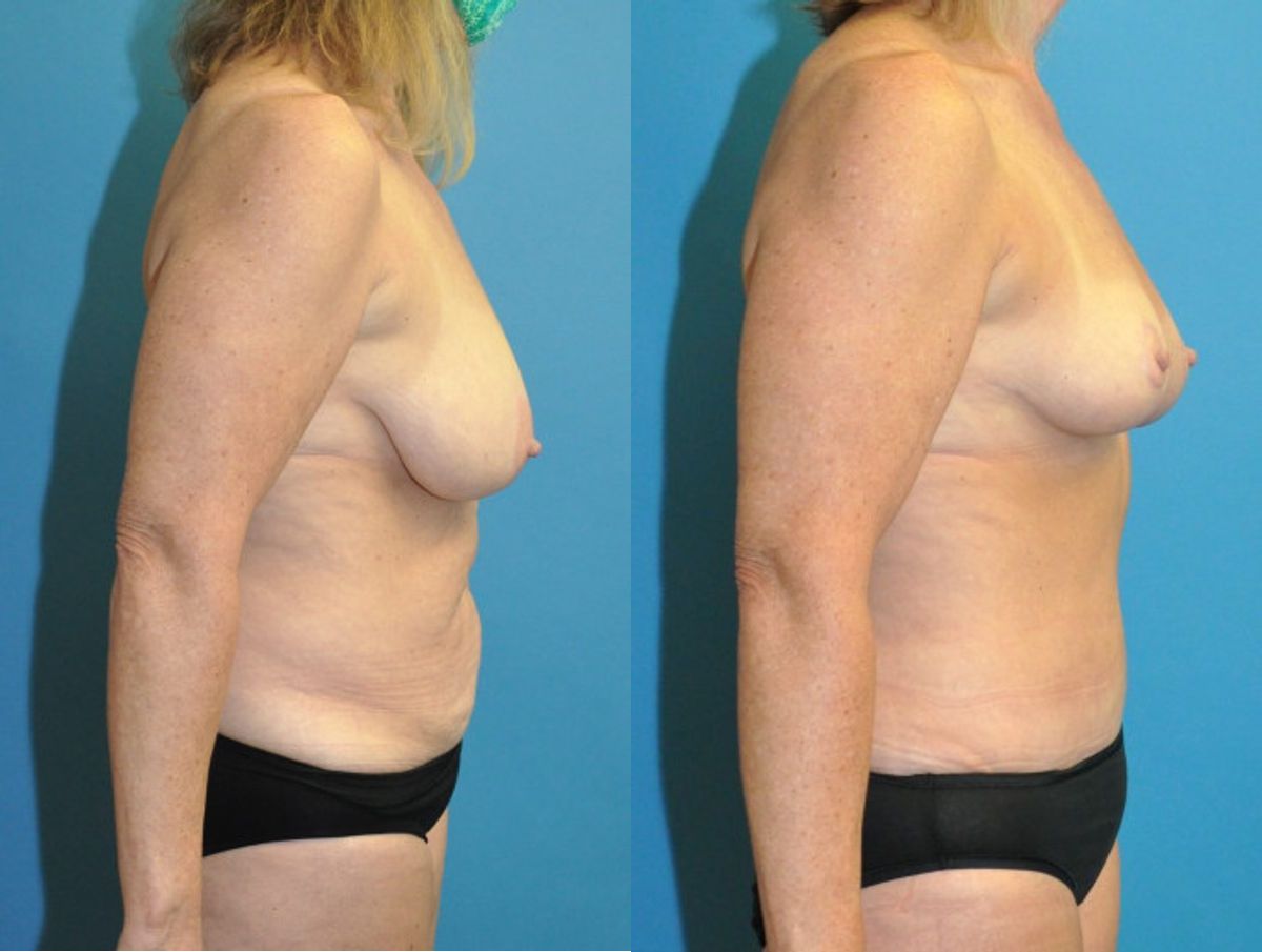 Mommy Makeover #21 - Before and After