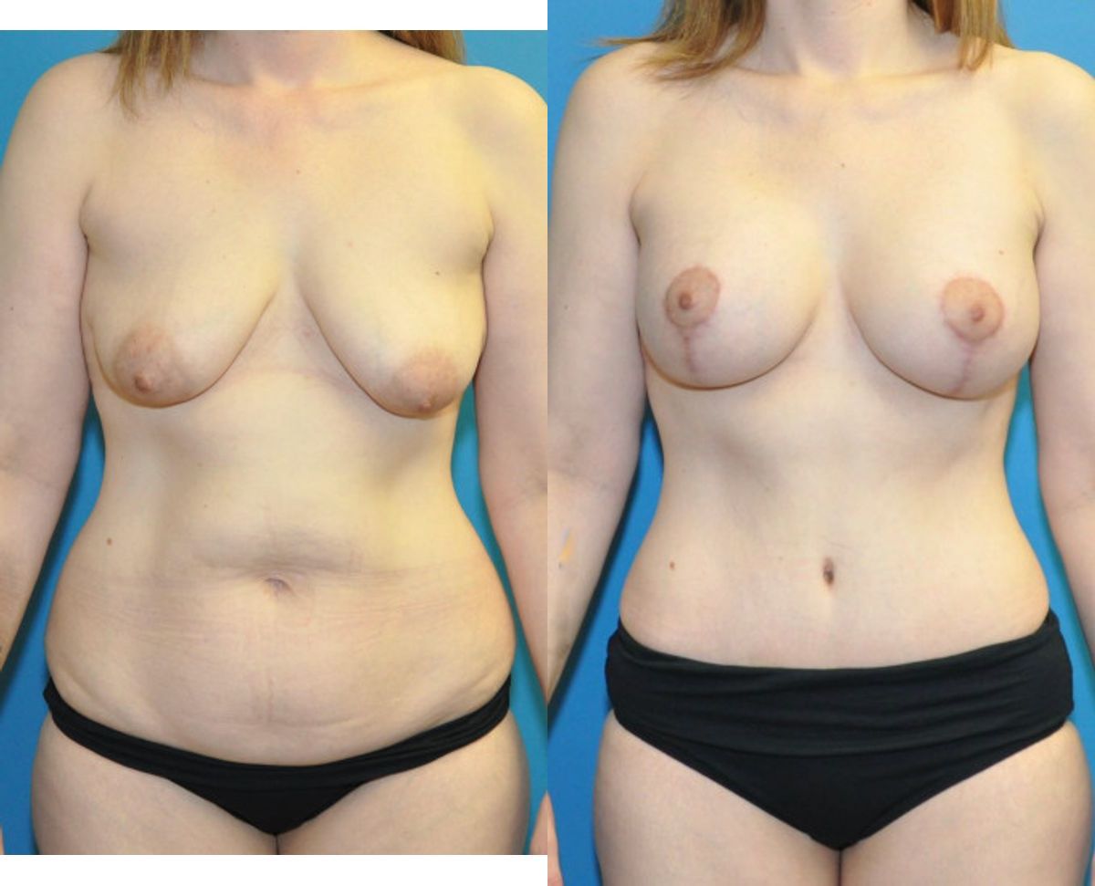 Mommy Makeover #22 - Before and After