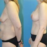 Mommy Makeover #22 - Before and After