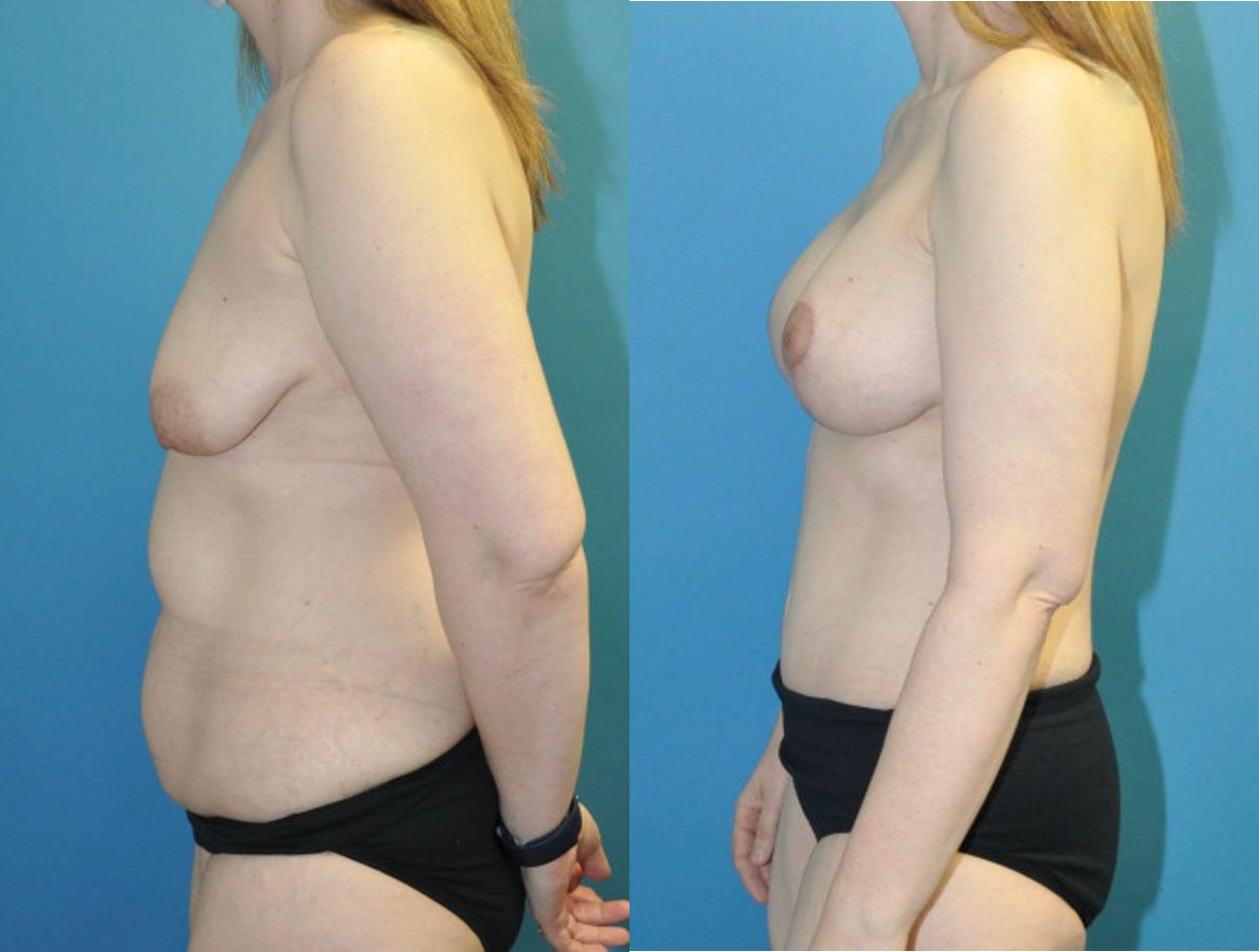 Mommy Makeover #22 - Before and After