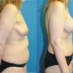 Mommy Makeover #22 - Before and After