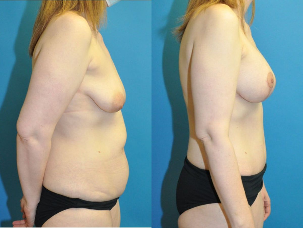 Mommy Makeover #22 - Before and After